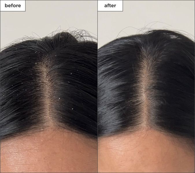 Косметичний засіб Briogeo Scalp Revival Charcoal and Tea Tree Buildup Detox Spray, 118 мл КОСМ03204 фото