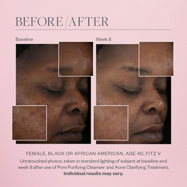 Косметичний засіб SkinMedica Acne Clarifying Treatment, 59 мл КОСМ00959 фото
