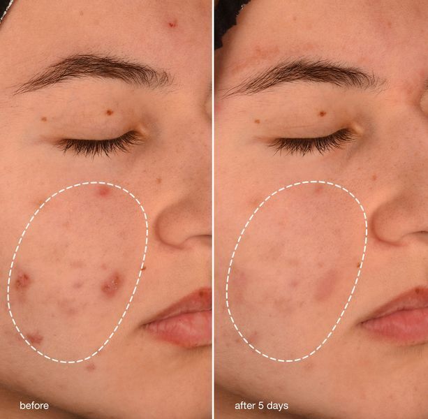 Увлажняющий крем Dermalogica Acne Biotic Moisturizer, 50 мл КОСМ01709 фото