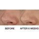 Косметичний засіб Clinique Blackhead Solutions Self-Heating Blackhead Extractor, 20 мл КОСМ00709 фото 4