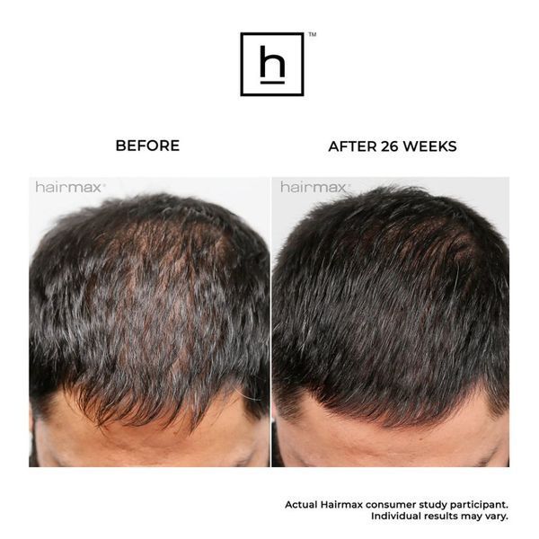 Hairmax Ultima 12 LaserComb &mdash; лазерний гребінець для росту волосся HM-1002 фото