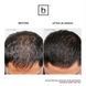 Hairmax LaserBand 82 ComfortFlex &mdash; лазерний пристрій для росту волосся HM-1010 фото 7