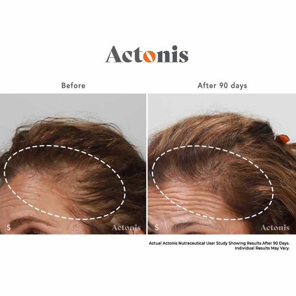 Hairmax Actonis Hair & Scalp &mdash; харчова добавка для волосся та шкіри голови HM-1011 фото