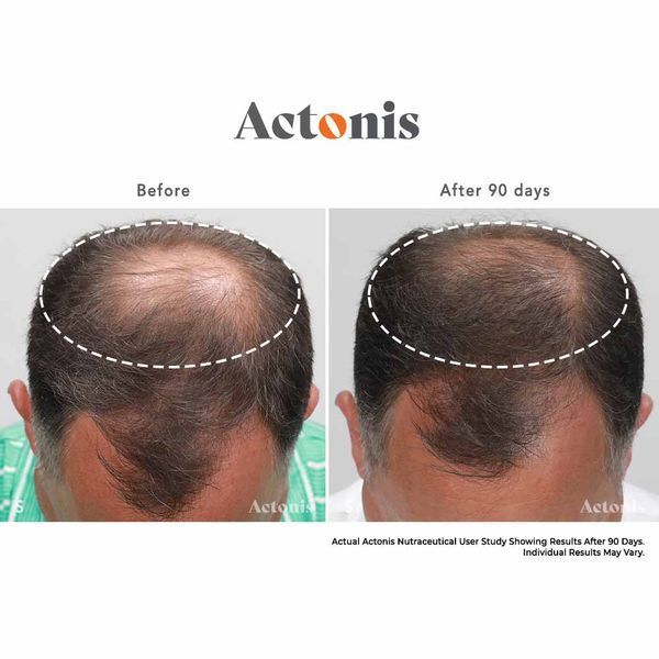 Hairmax Actonis Hair & Scalp &mdash; харчова добавка для волосся та шкіри голови HM-1011 фото