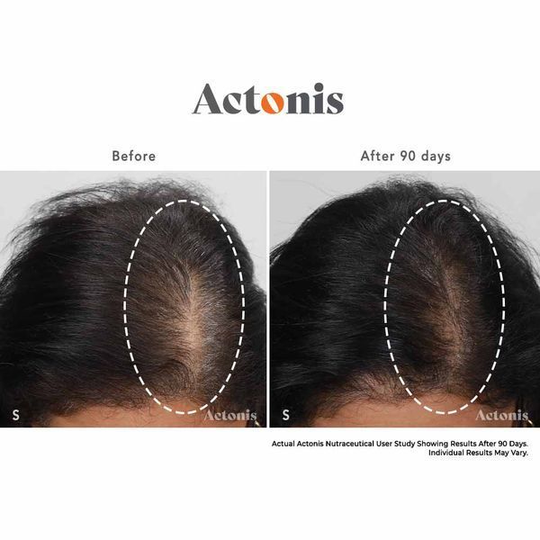Hairmax Actonis Hair & Scalp &mdash; харчова добавка для волосся та шкіри голови HM-1011 фото