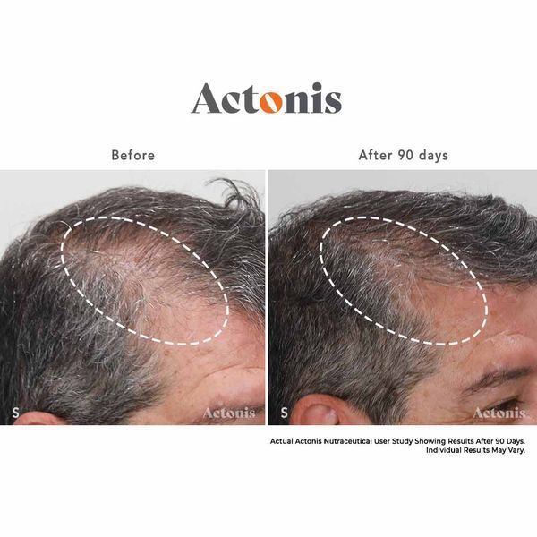 Hairmax Actonis Hair & Scalp &mdash; харчова добавка для волосся та шкіри голови HM-1011 фото