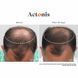 Hairmax Actonis Hair & Scalp &mdash; харчова добавка для волосся та шкіри голови HM-1011 фото 9