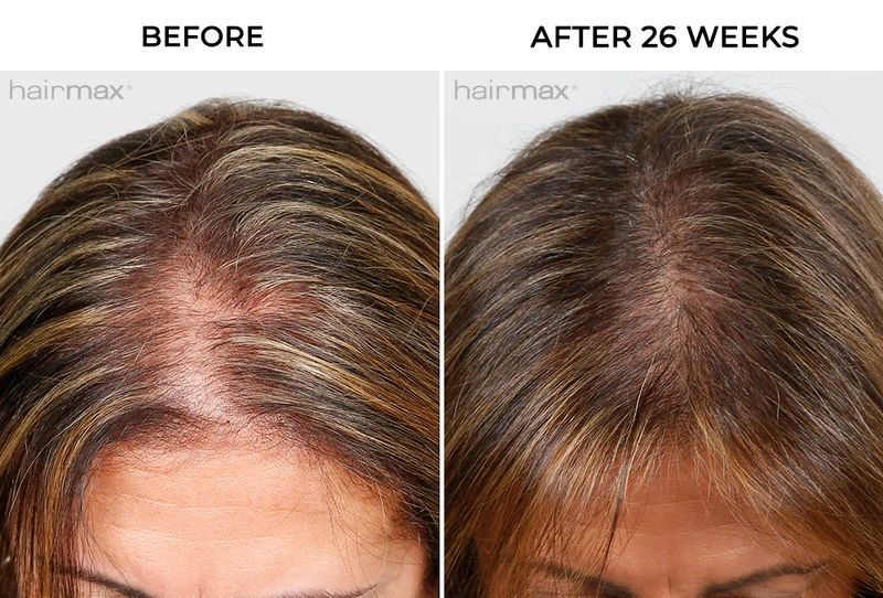 Hairmax PowerFlex Laser 272 Cap &mdash; лазерна кепка для росту волосся HM-1012 фото