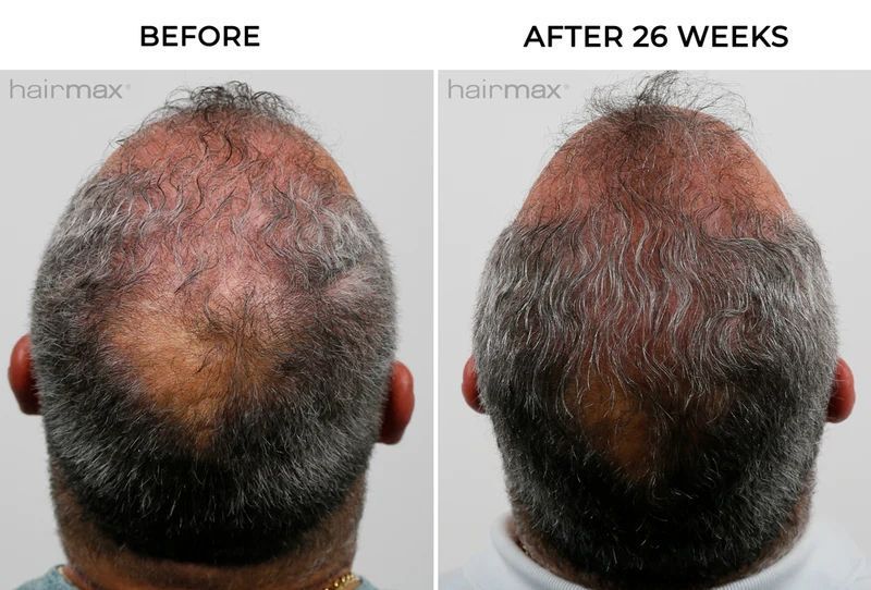 Hairmax PowerFlex Laser 272 Cap &mdash; лазерна кепка для росту волосся HM-1012 фото