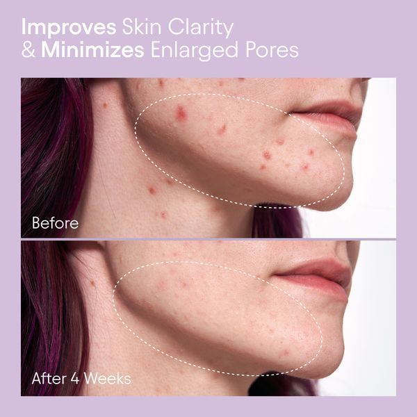 Косметичний засіб Alpyn Beauty Pore Perfecting Liquid with 2% BHA and Borage, 118 мл КОСМ01880 фото