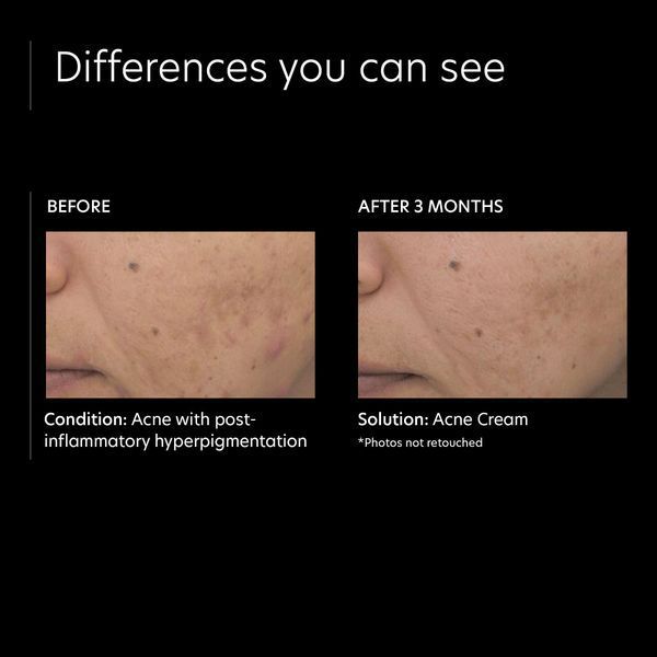 Косметичний засіб PCA Skin Acne Cream, 15 мл КОСМ00833 фото