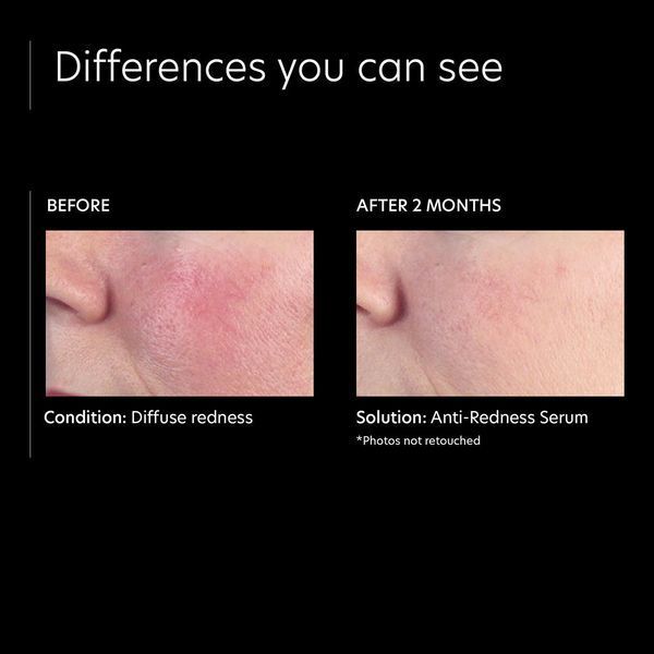 Косметичний засіб PCA Skin Anti-Redness Serum, 30 мл КОСМ00835 фото
