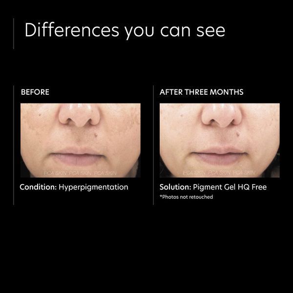 Косметичний засіб PCA Skin Pigment Gel HQ Free, 30 мл КОСМ01397 фото